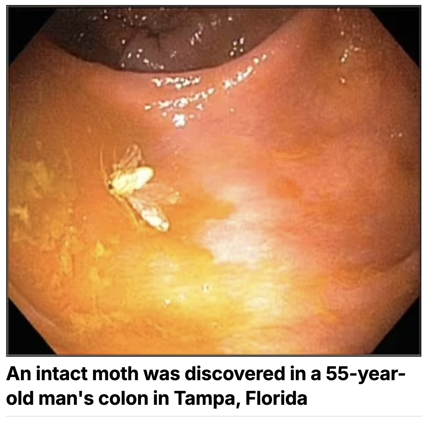 photo caption - Ym An intact moth was discovered in a 55year old man's colon in Tampa, Florida